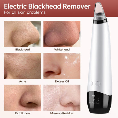 Blackhead Remover